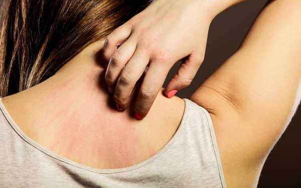 What Causes Plaque Psoriasis? Here's What Your Doctor Needs To Tell You