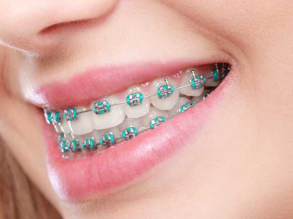 Affordable Orthodontic Solutions and Modern Braces in the UK: 2025 Guide