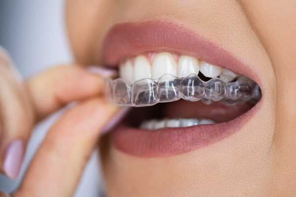 Affordable Orthodontic Solutions and Modern Braces in the U.S.: 2025 Guide