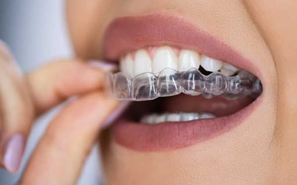 Invisible Dental Implants in the UK 2025: Advantages, Choices, and How They Compare with Traditional Options